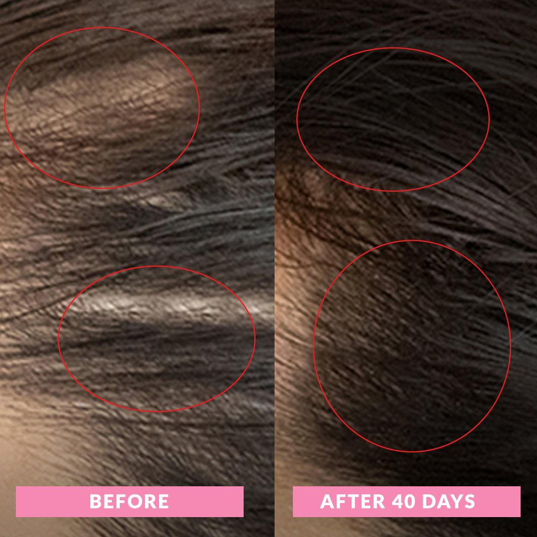 11 Hairloss-Before-After-Daily-supplement