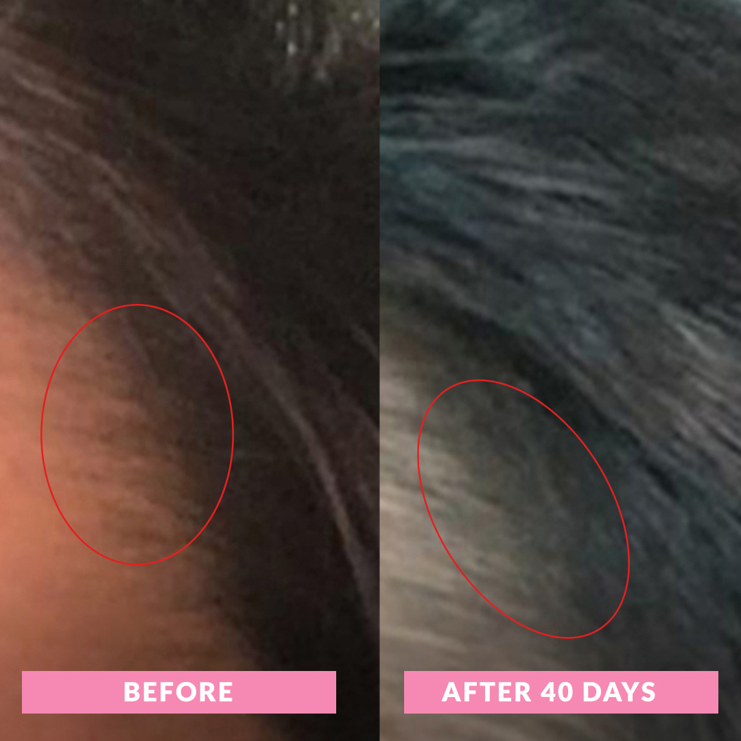 6 Hairloss-Before-After-Daily-vitamin